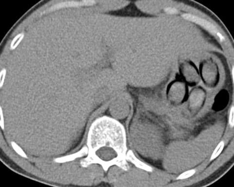 Röntgenbild zeigt Kokainpäckchen im Magen eines niederländischen Drogenkurierers am Flughafen Köln.